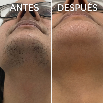 Lumea | Serum oil Inhibidor de vello.