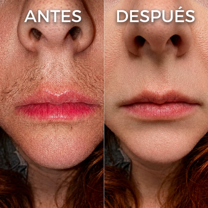 Lumea | Serum oil Inhibidor de vello.